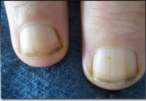 指甲里的秘密:指甲异常与全身性疾病 作者:rain