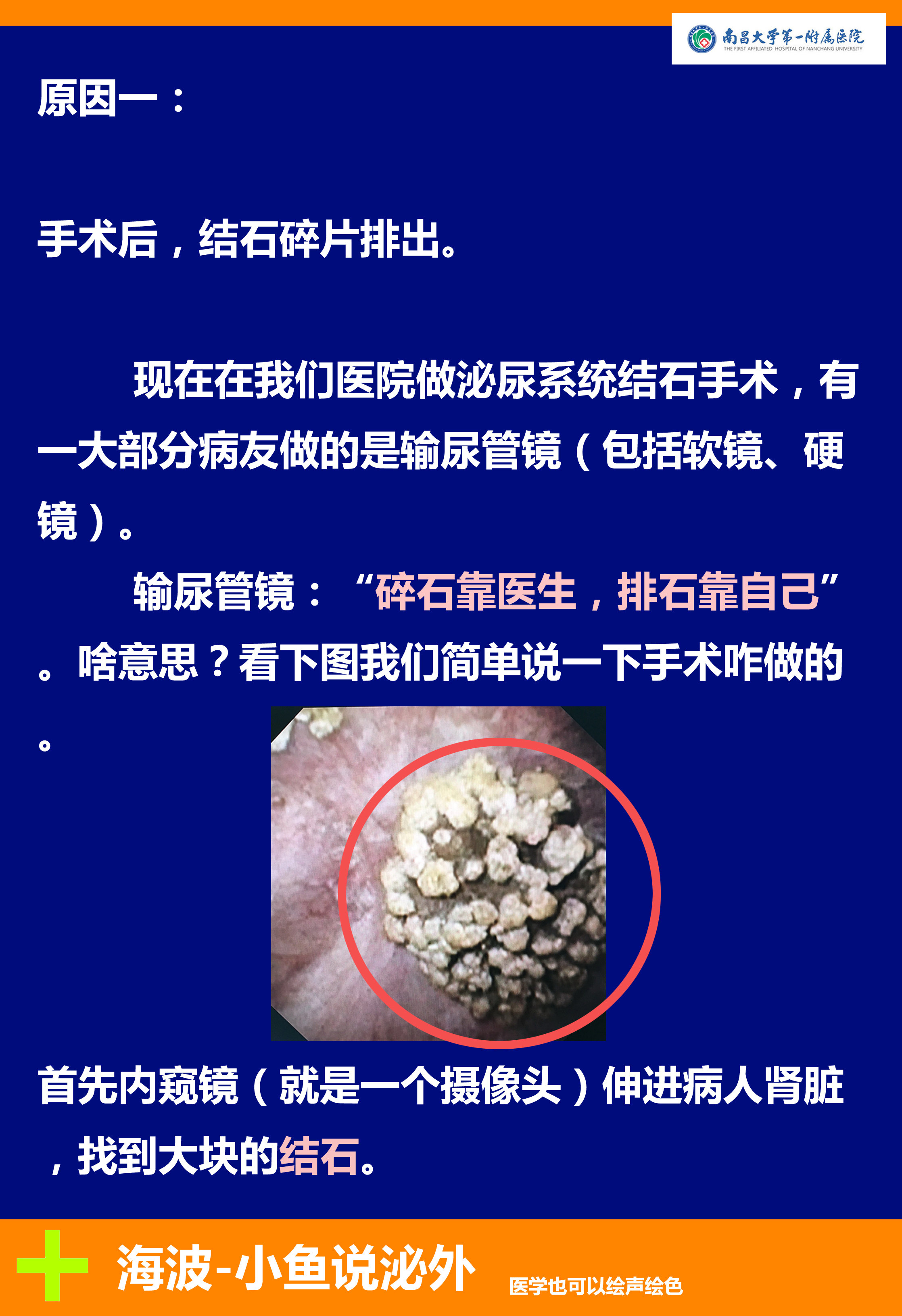 肾结石,输尿管结石术后的不适