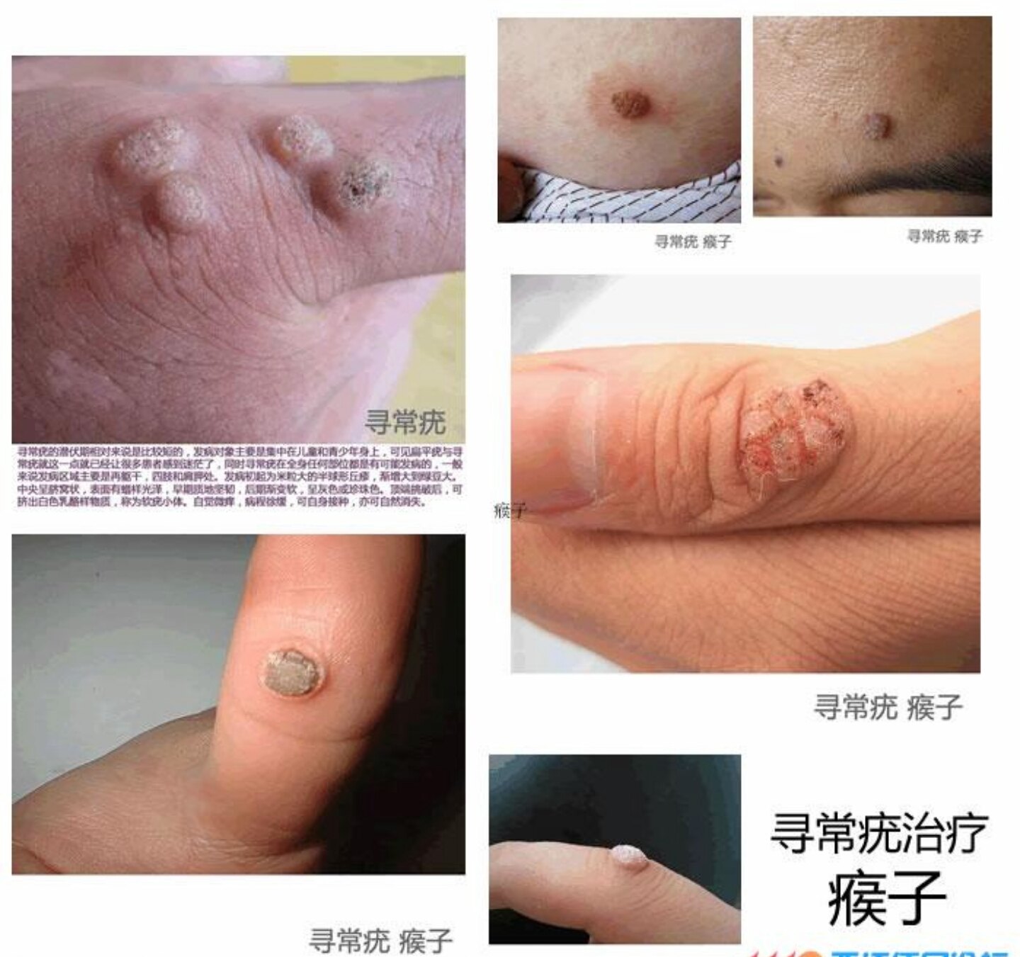 扁平疣寻常疣刺瘊子鸡眼怎么回事啊