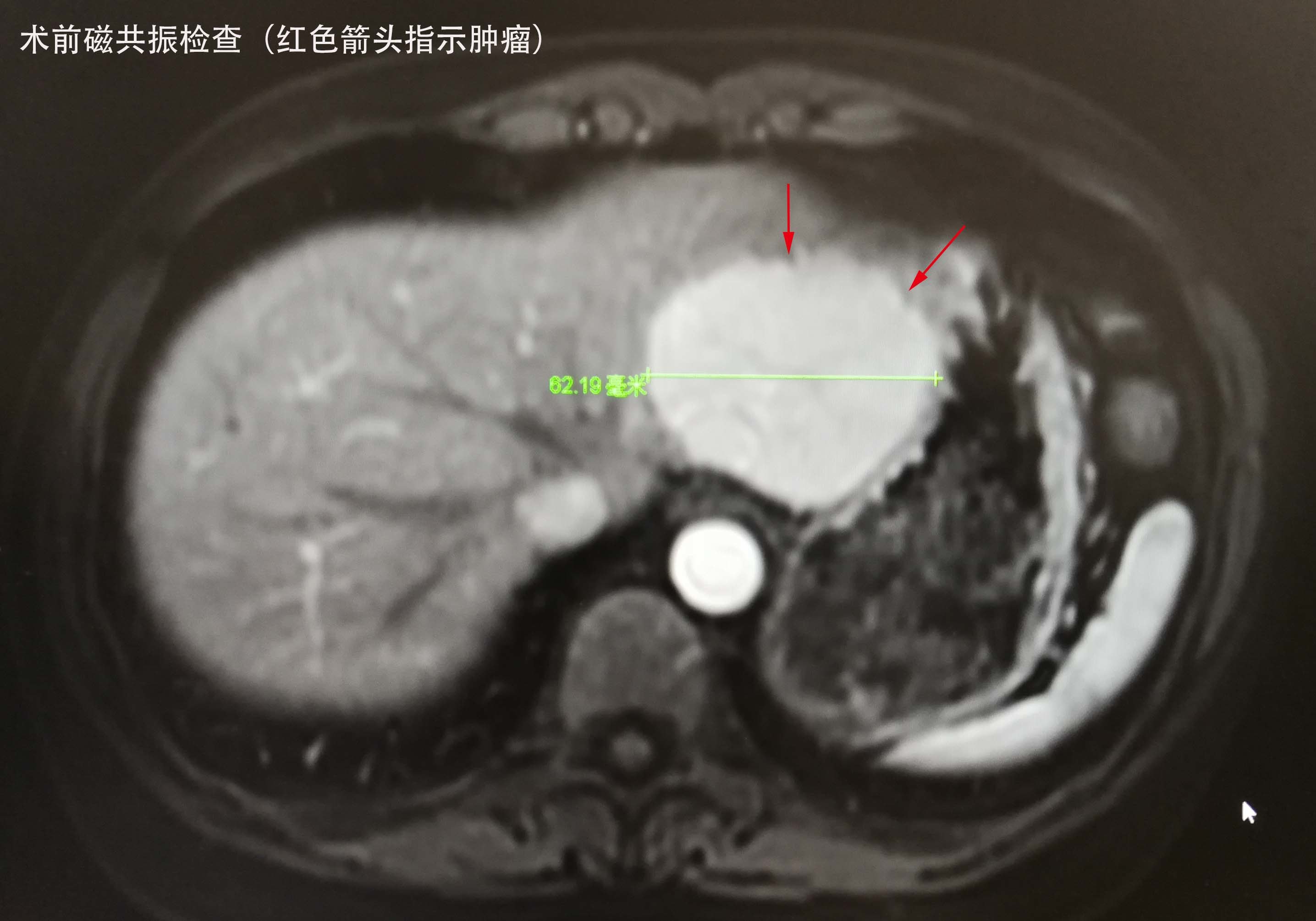 肝肿瘤的腹腔镜微创手术切除一例 - 好大夫在线
