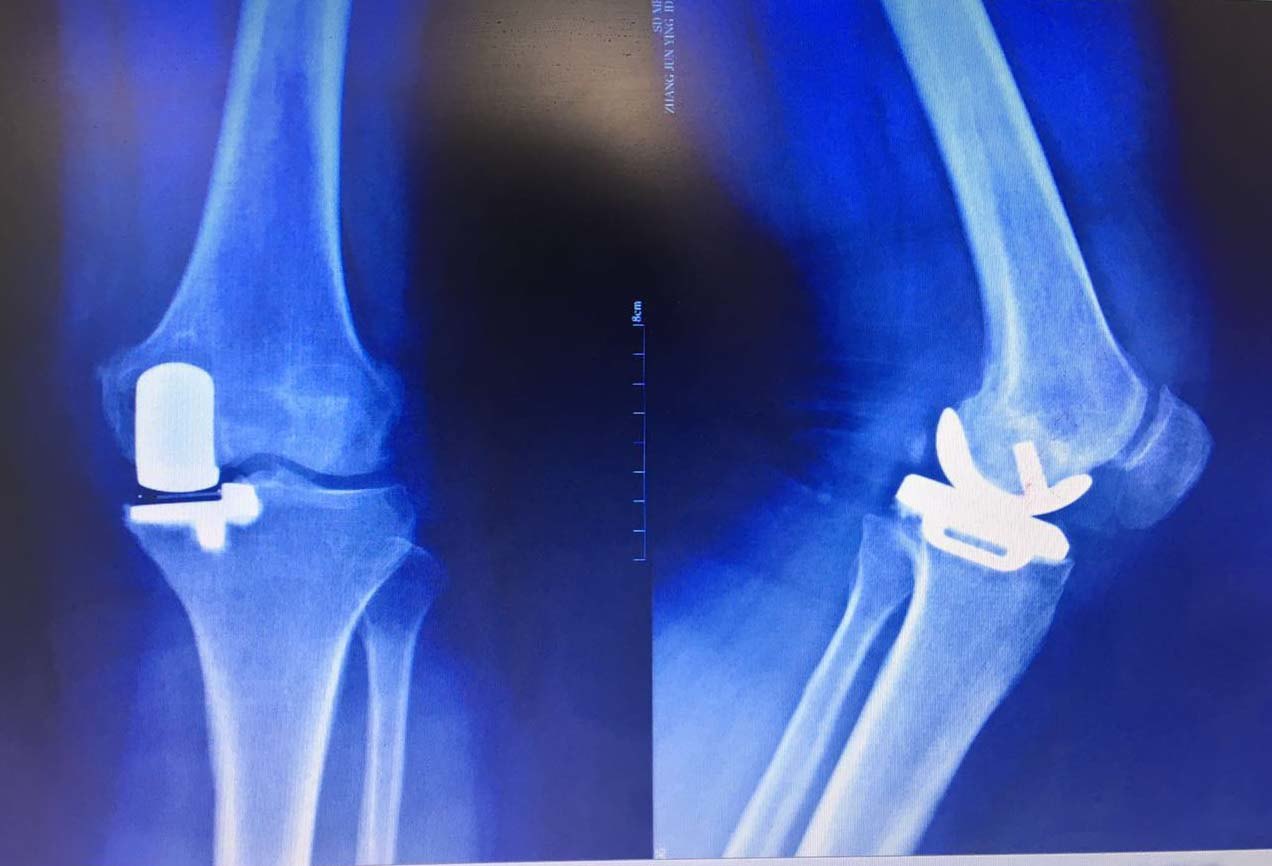 术后膝关节正侧位x线片显示假体位置良好