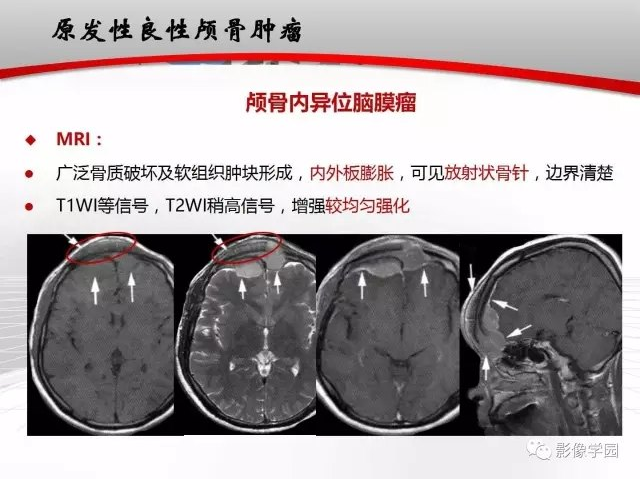 原发性颅骨肿瘤及肿瘤样变的影像学表现