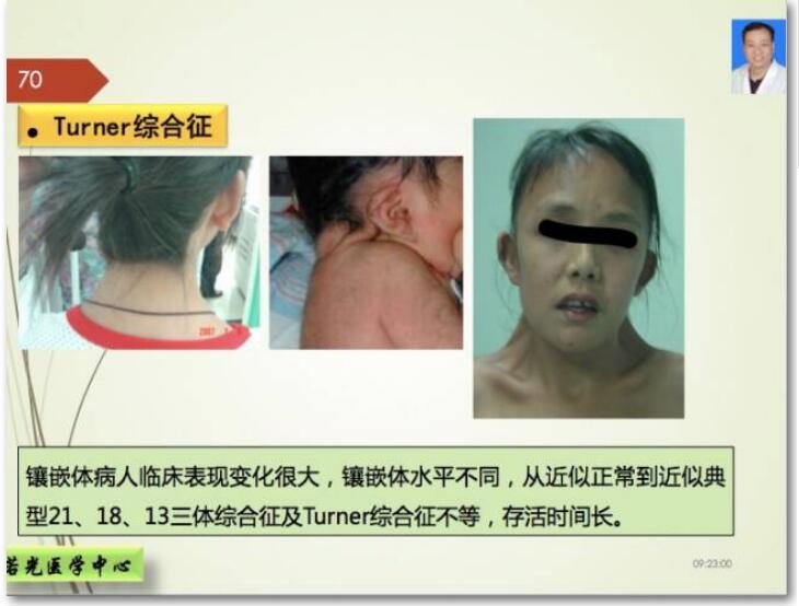 染色体病之特纳综合征45xo