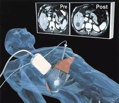 超声引导微波消融治疗肝癌