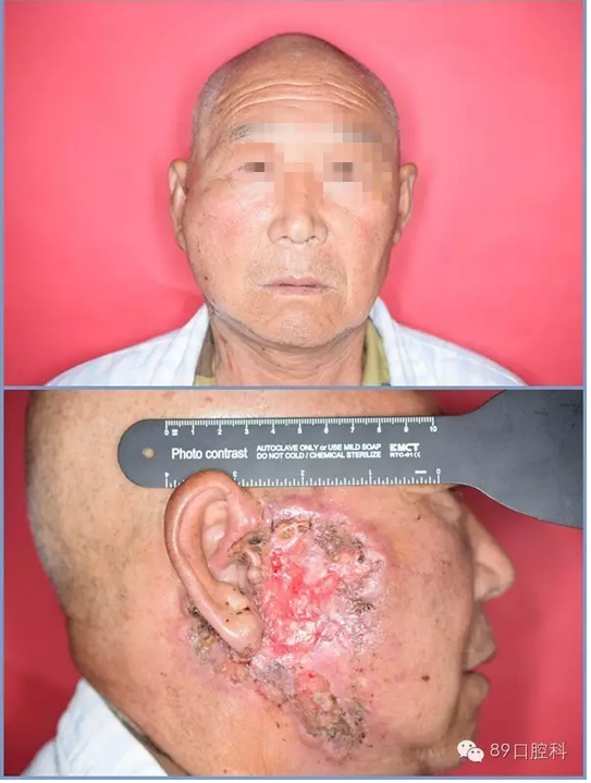 该患者肿瘤约8cm×12cm,侵及外耳道,病理结果为中分化鳞状细胞癌.