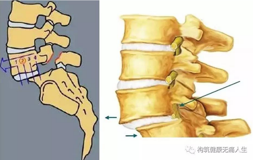 腰椎滑脱症