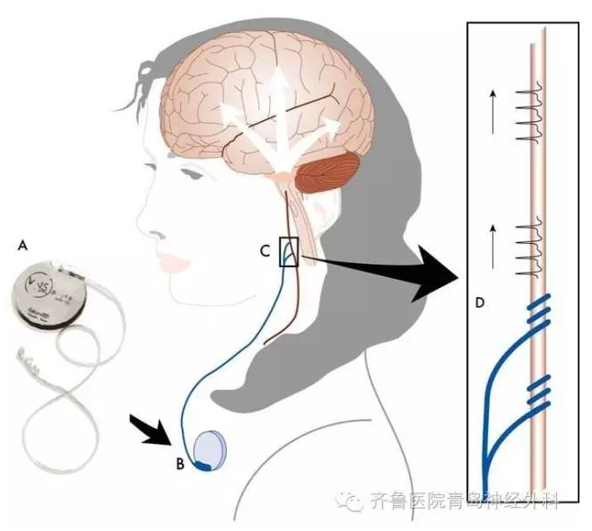 迷走神经电刺激术治疗难治性癫痫