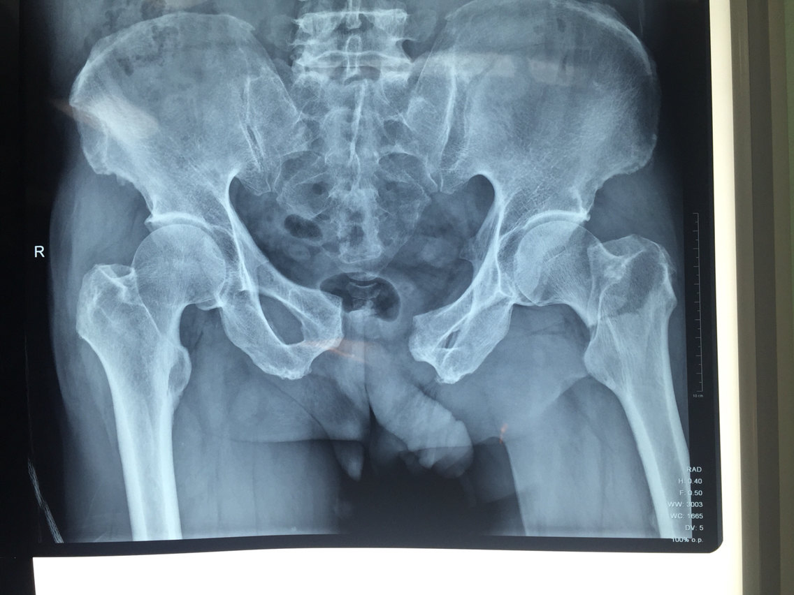 32岁左股骨颈基底部骨折合并耻骨联合分离,采用内固定
