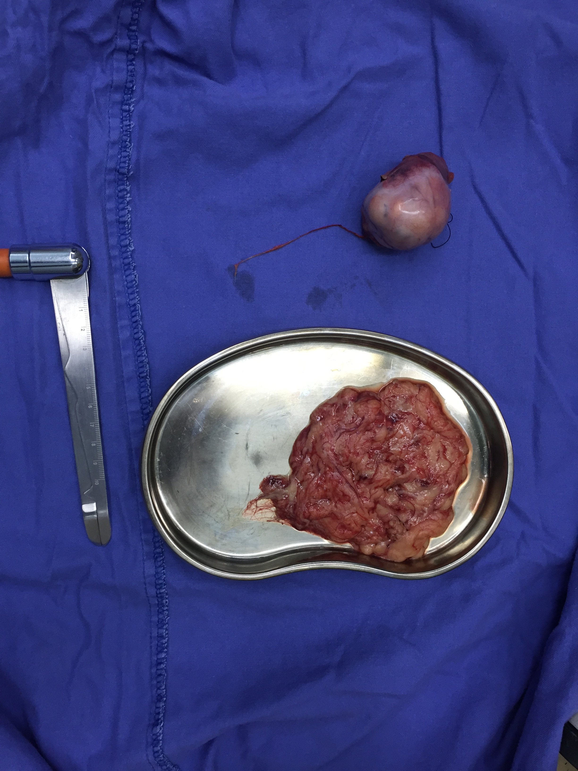 生殖细胞肿瘤 www.haodf.com