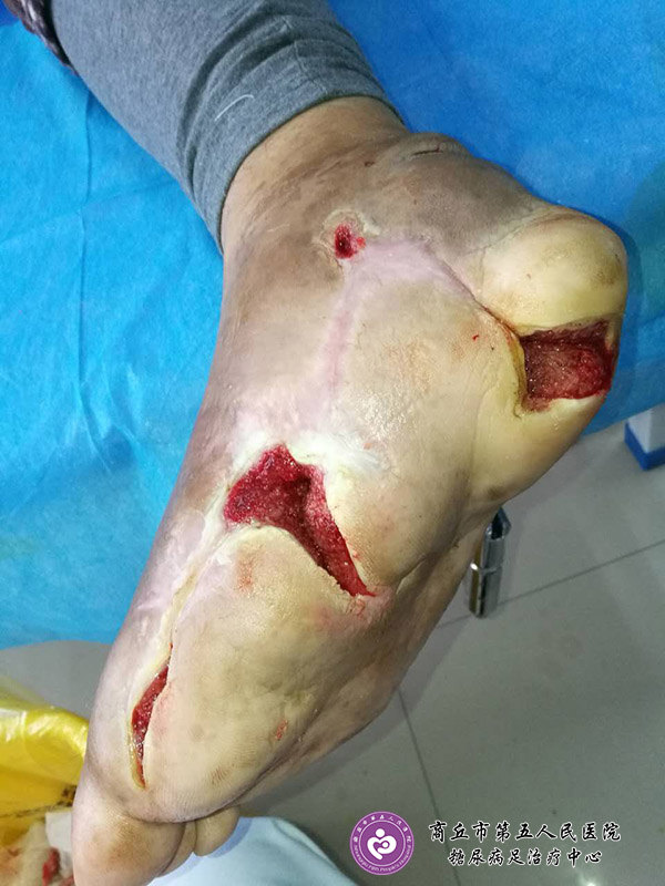 糖尿病人脚底化脓溃烂一定要截肢吗 - 好大夫在