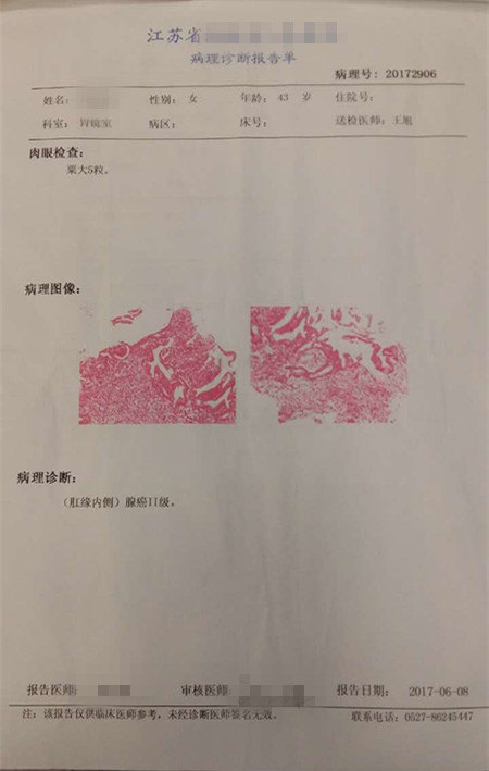 低位直肠癌改良isr手术