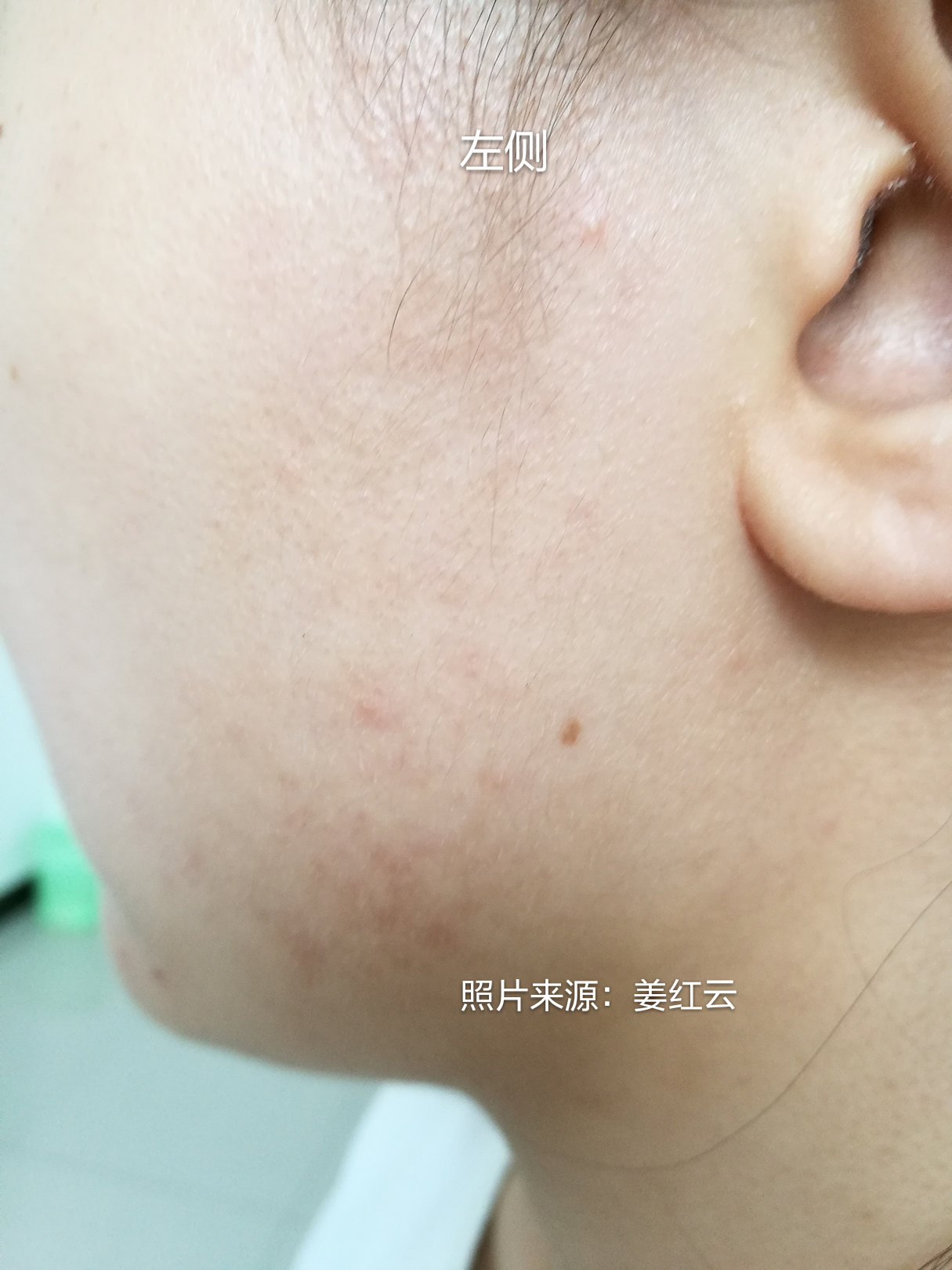 损容性皮肤病 ___ 面颈部红斑黑变病.