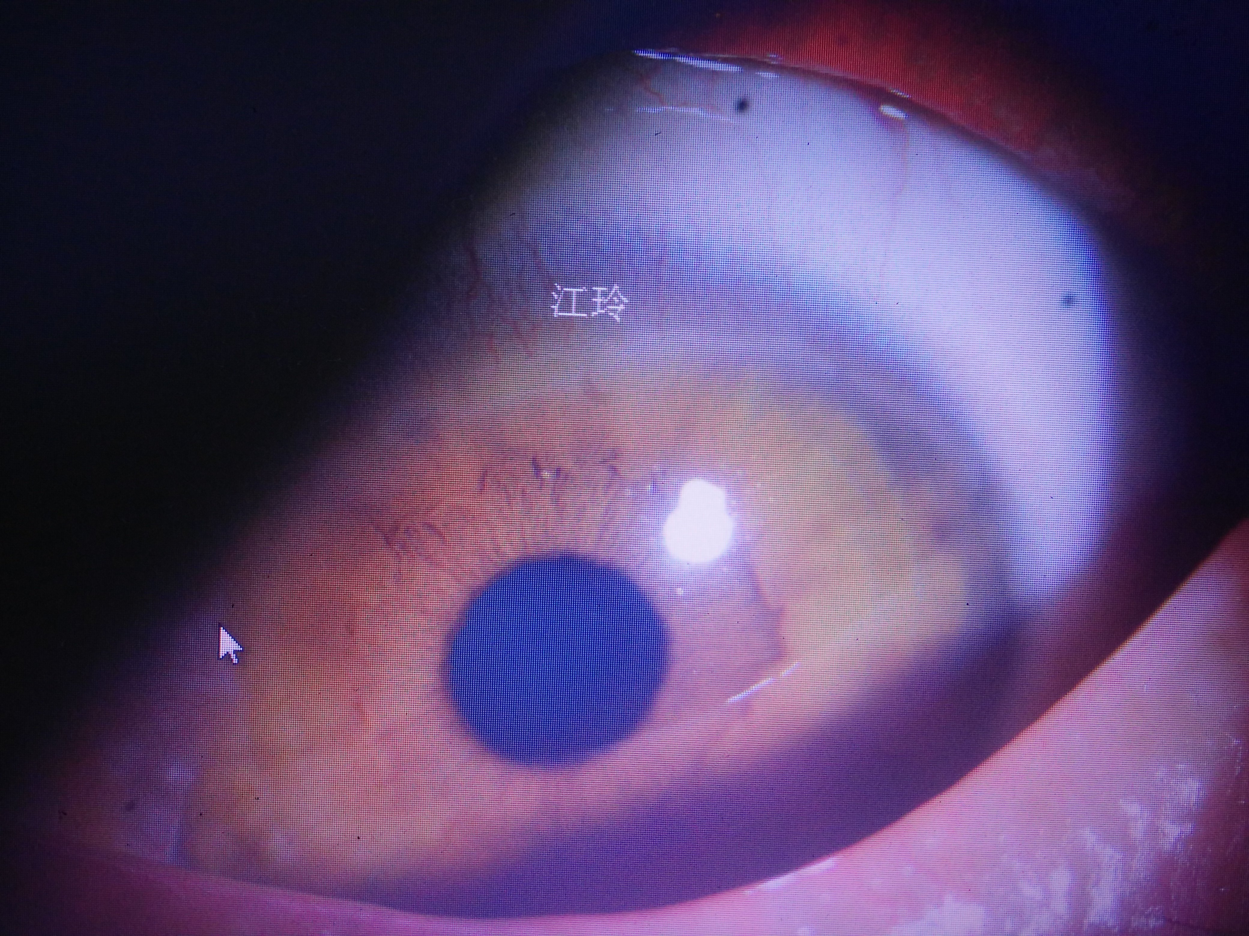治疗后左眼瞳孔上方角膜边缘恢复的情况.