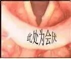 是以会厌黏膜为主的急性炎症,起病突然,进展迅速,可以喉阻塞引起窒息