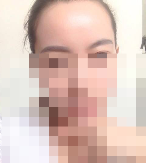 植发手术术后多久能够去见人?