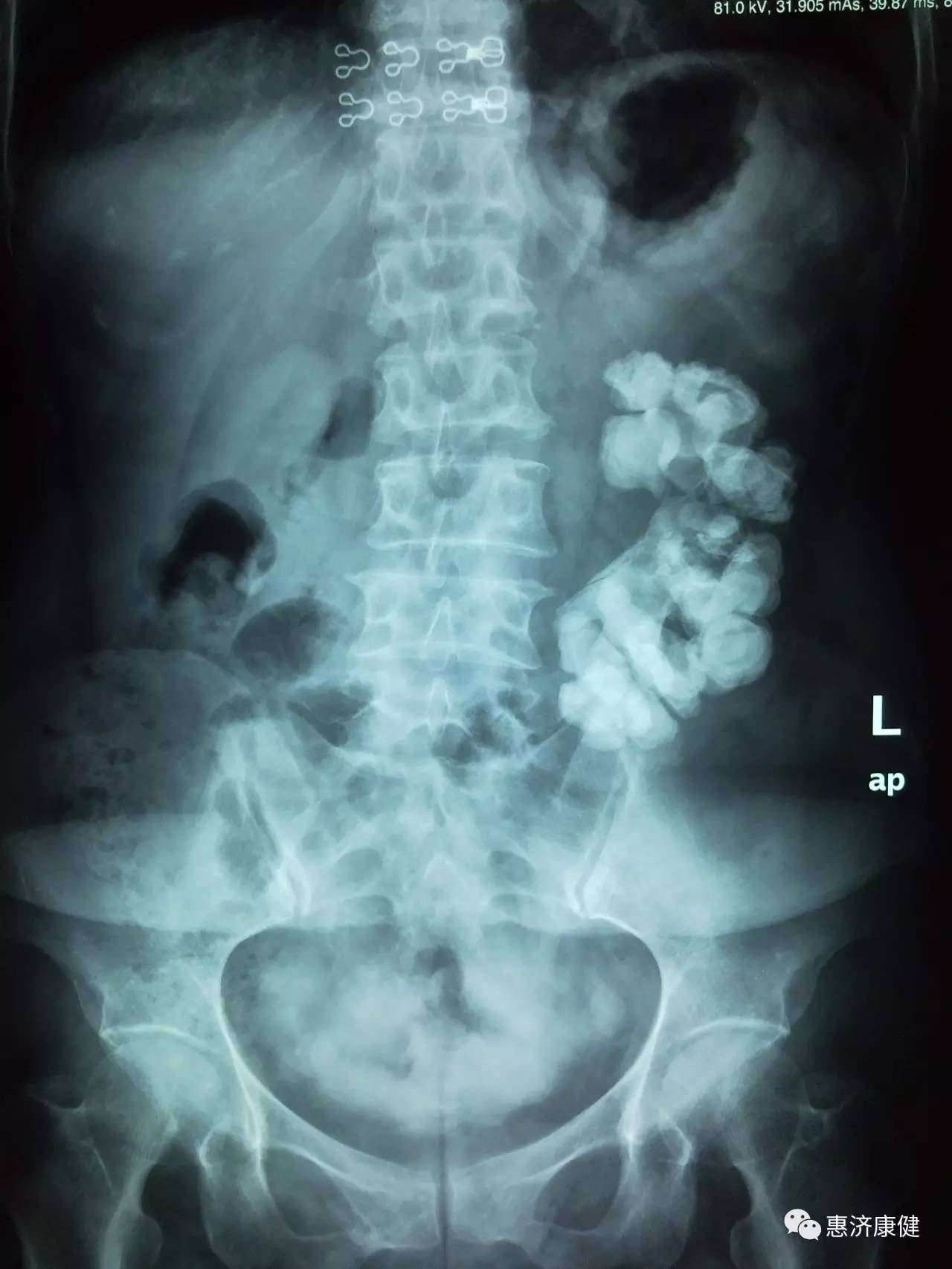 5分钟让你了解泌尿系结石