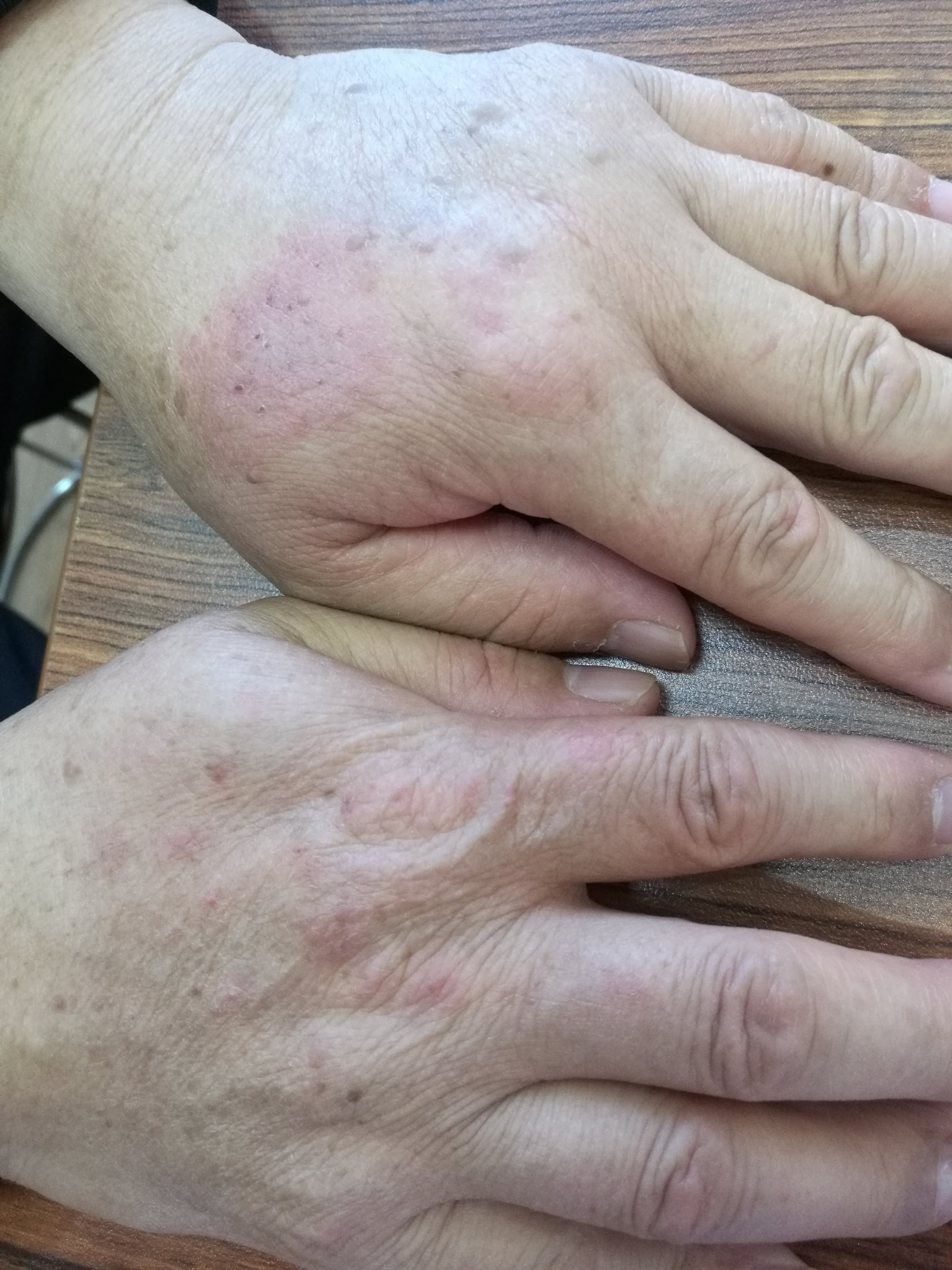 图50手背皮肤湿疹(同上)