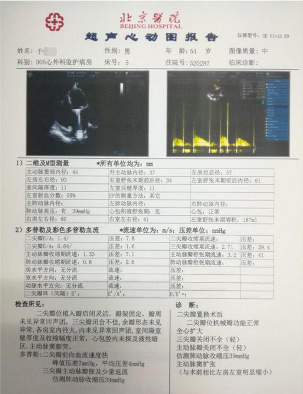 手术治疗心脏瓣膜病——二尖瓣病变合并巨大左心房