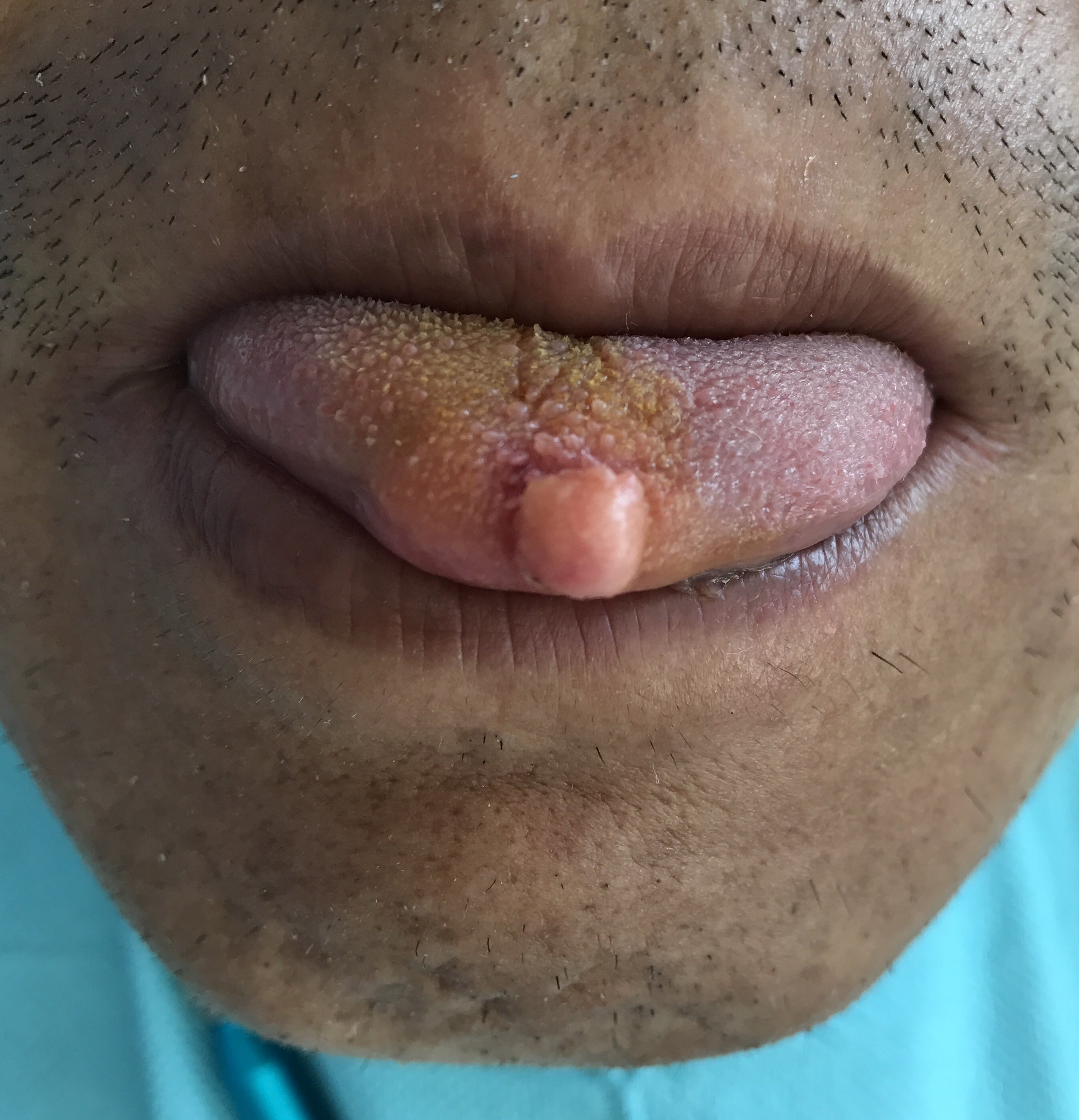 哪些口腔良性病变适合激光治疗(一)