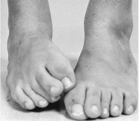 严重的足部畸形任由畸形存在不处理,孩子只能垫脚走路,与地面接触的