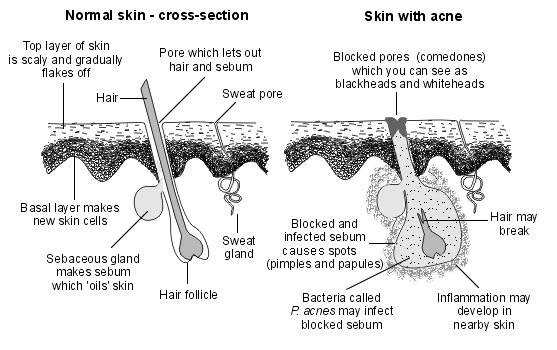 normal-acne-.jpg