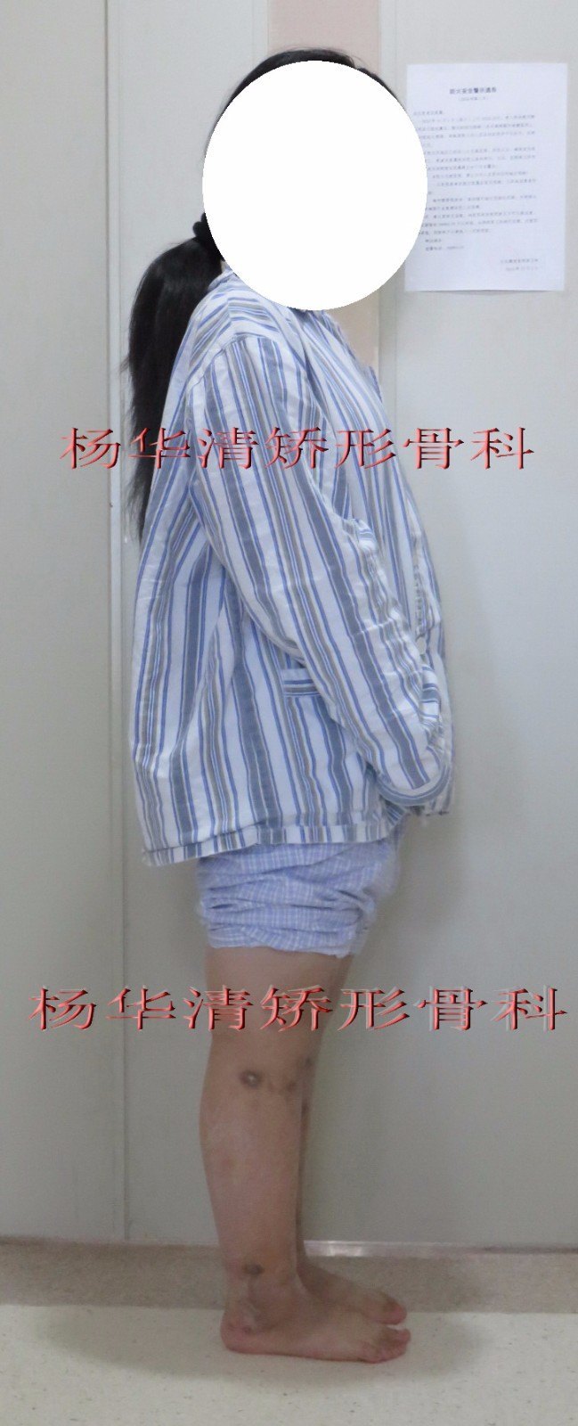 o型腿 o形腿(重度膝内翻病例)