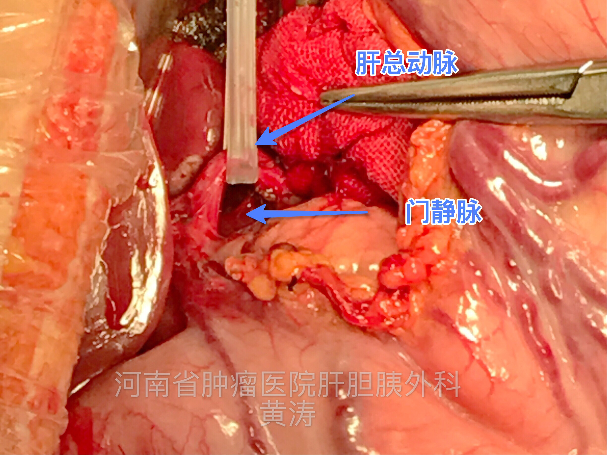 黄涛 文章列表  于胰腺上缘分离出肝总动脉,并向远端分离,分离出胃右