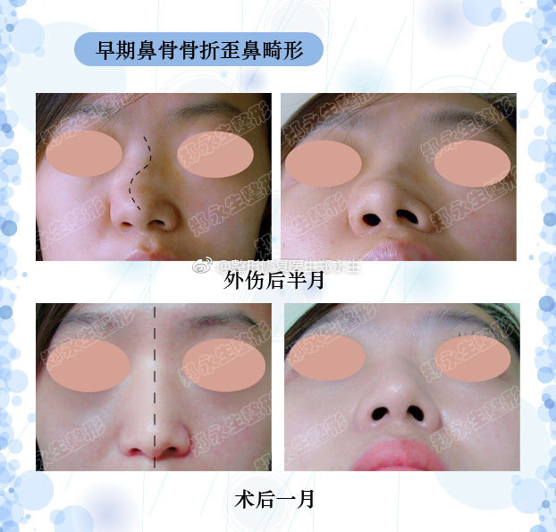 歪鼻是常见的鼻部畸形,多为外伤引起,也有先天