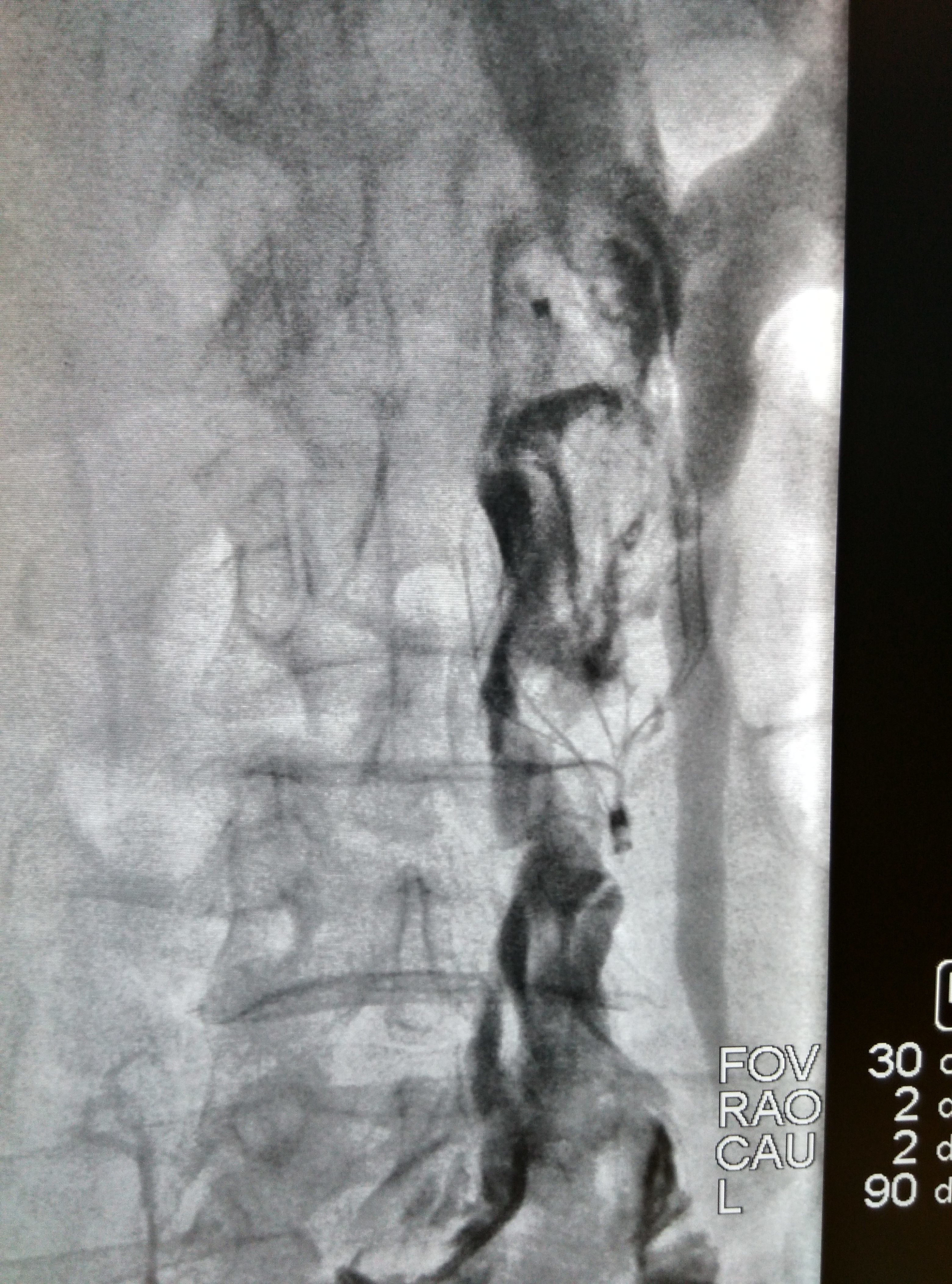 下肢静脉血栓与肺栓塞
