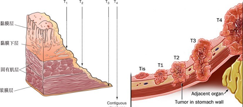胃壁结构及t分期
