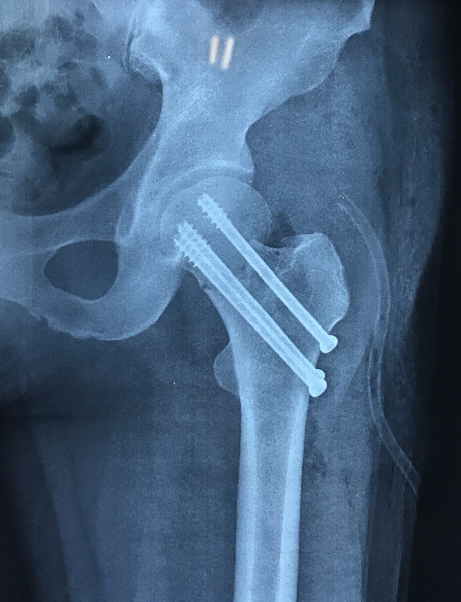 股骨颈骨折内固定术后警惕继发性骨坏死病例分享