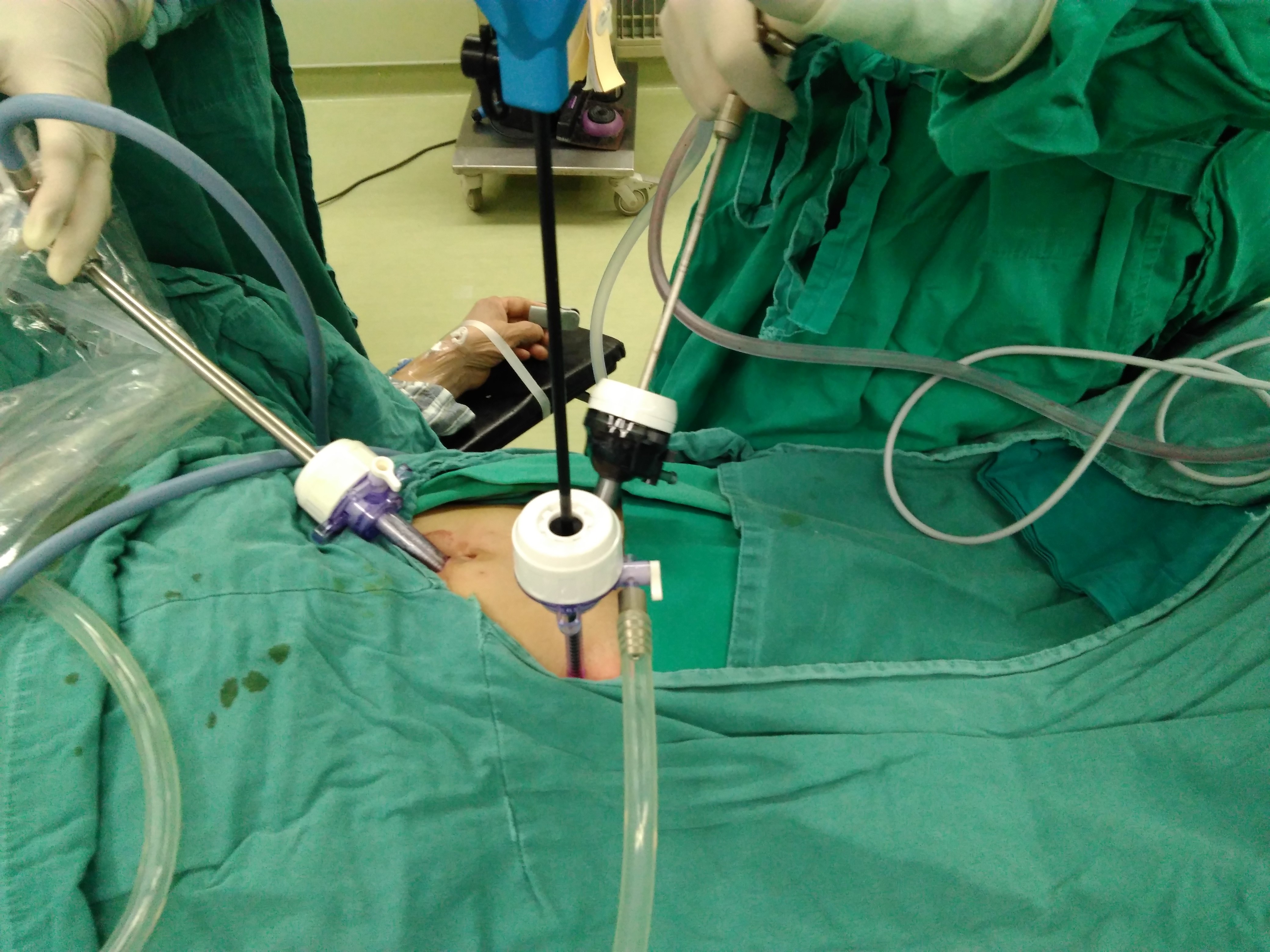 急性阑尾炎穿孔行腹腔镜手术治疗是患者最佳手术方式