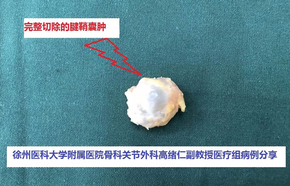 腕关节包块腱鞘囊肿怎么治疗?一定要手术切除吗?如何手术?