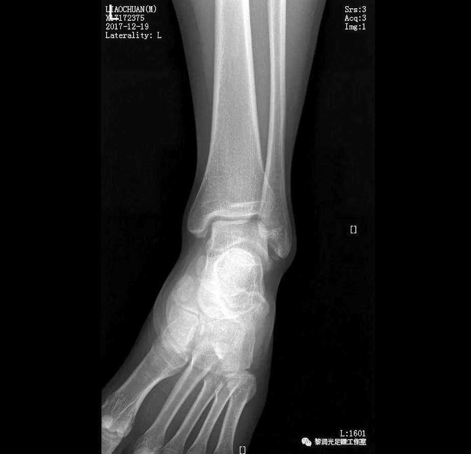 黎润光 文章列表  患者,男,22岁,足踝扭伤 疼痛 半年 x光片显示腓骨
