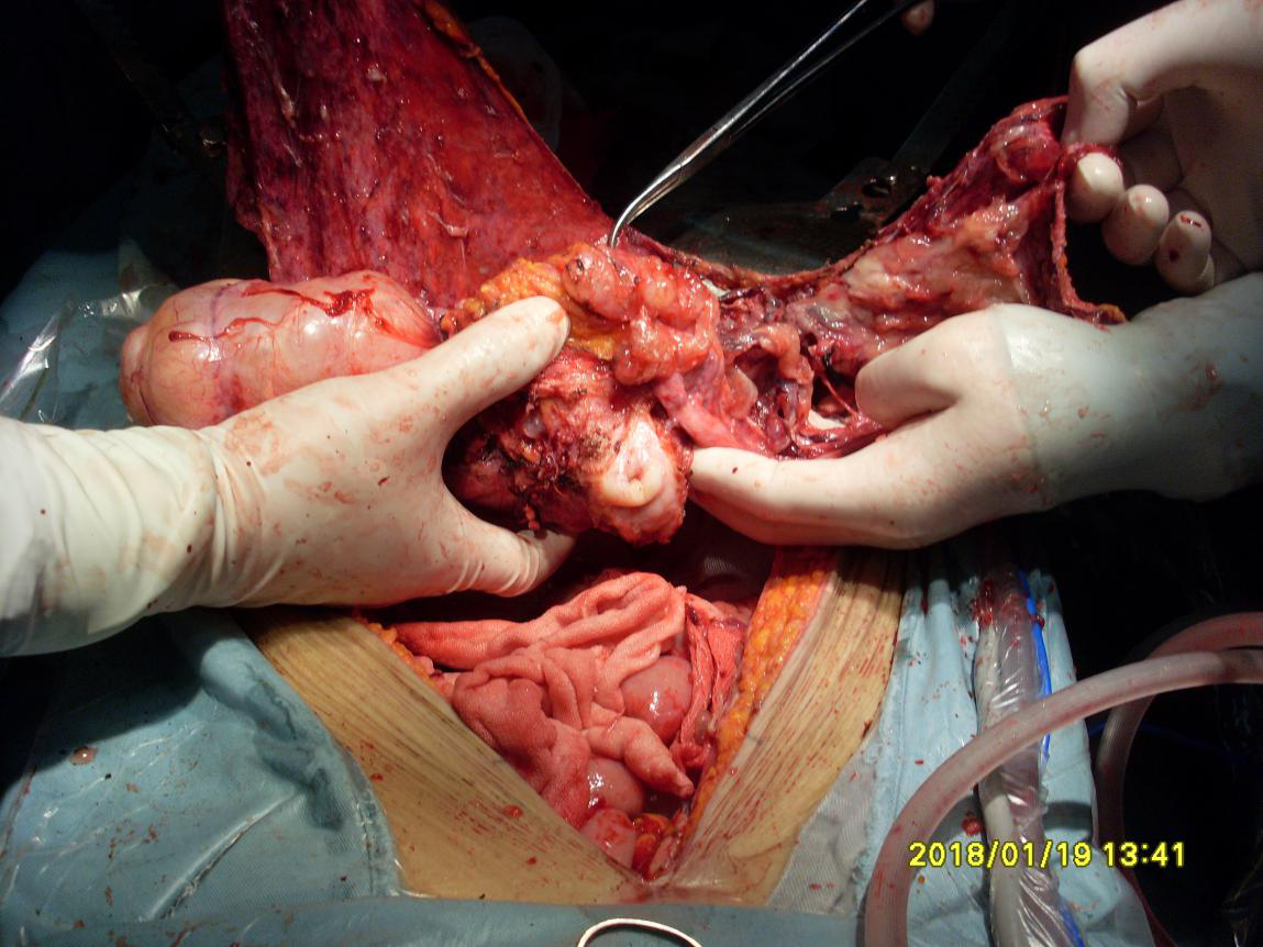 上图为切除盆底腹膜,子宫,缝合阴道残端后情况.