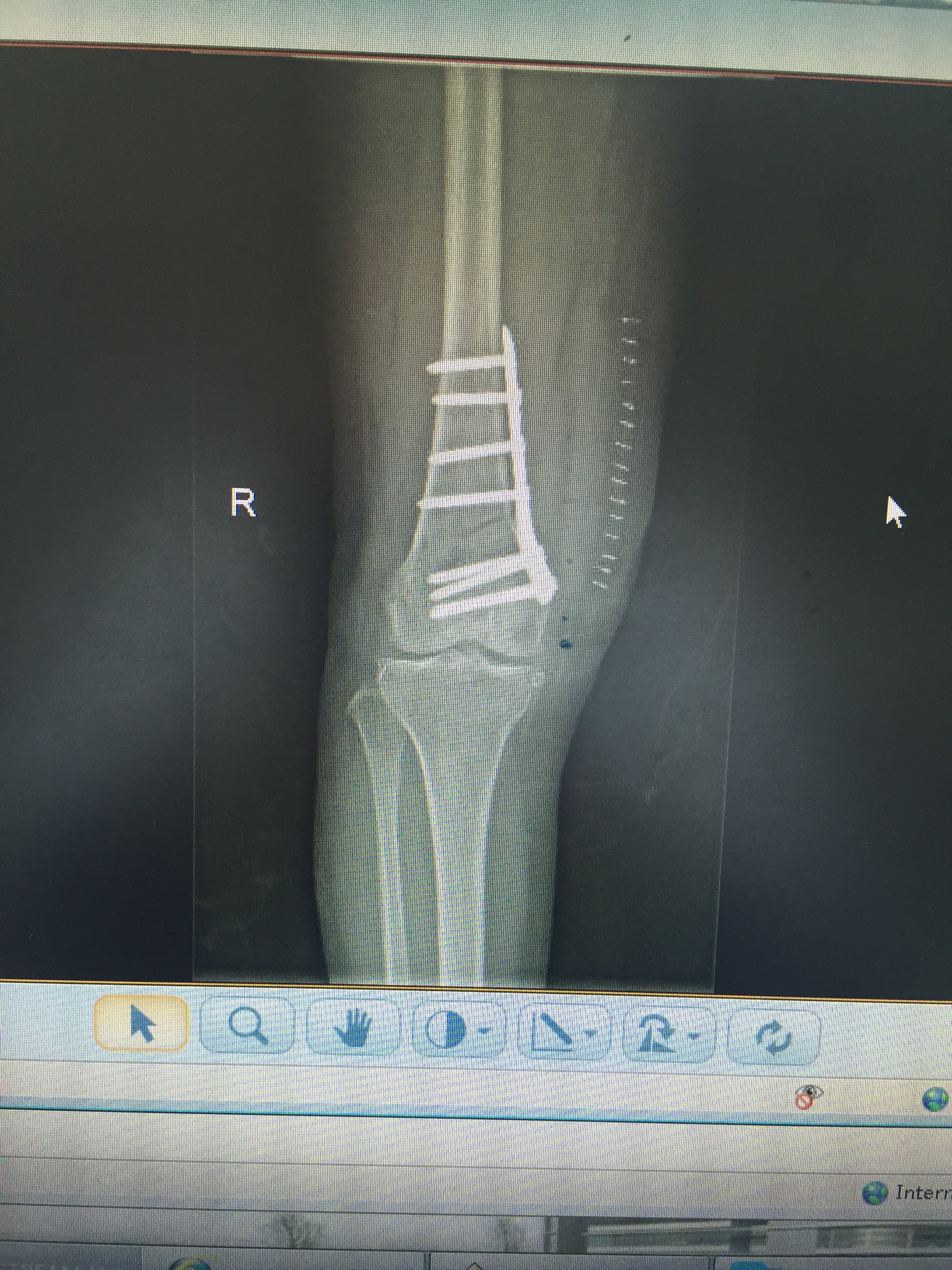保膝术股骨远端截骨在膝外翻治疗中应用