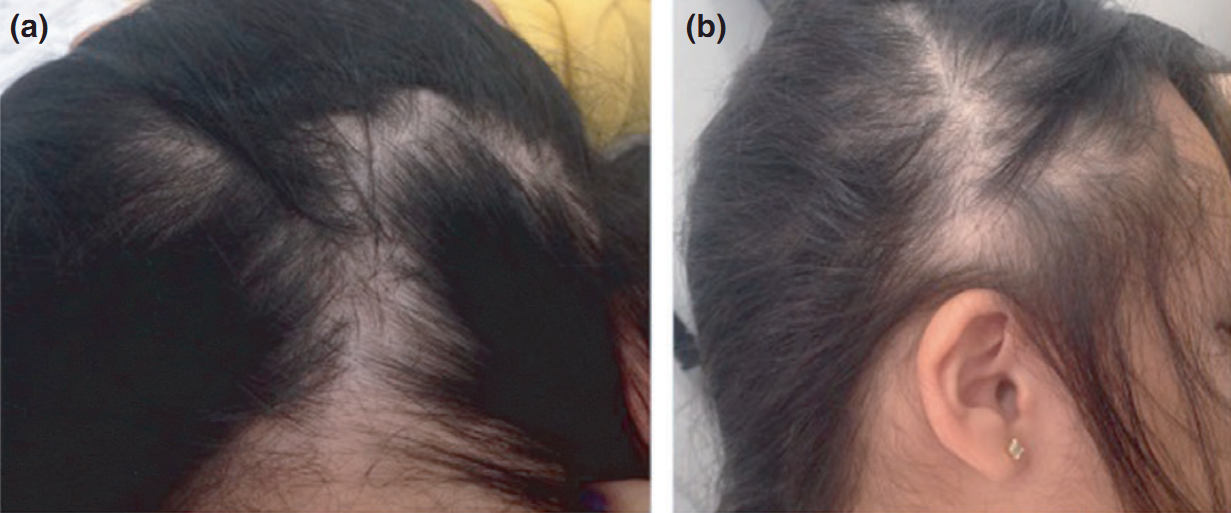 病例一是一位14岁女性,在过去的4个月中,在上颌枕区有弥漫性脱发(图