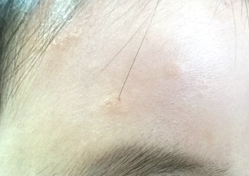 玫瑰糠疹知多少