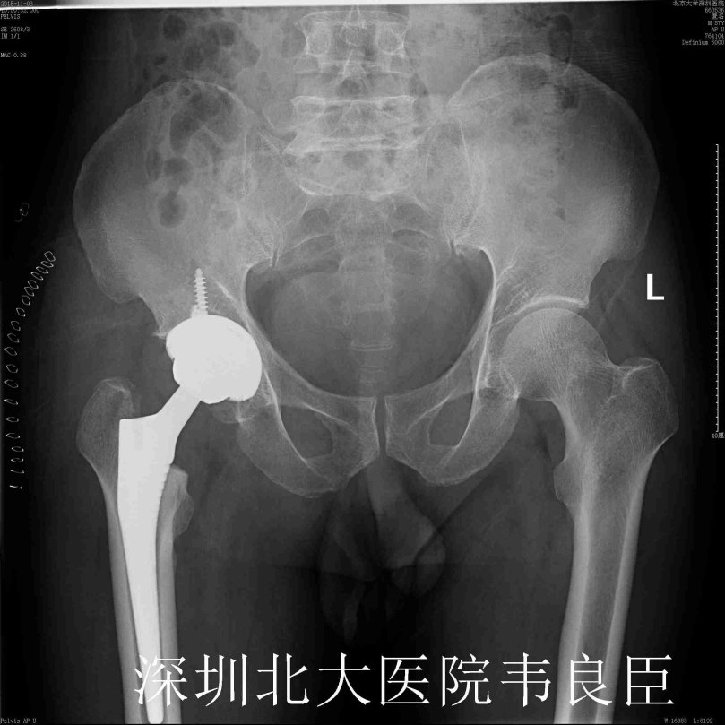 股骨头坏死行人工髋关节置换术x片示例