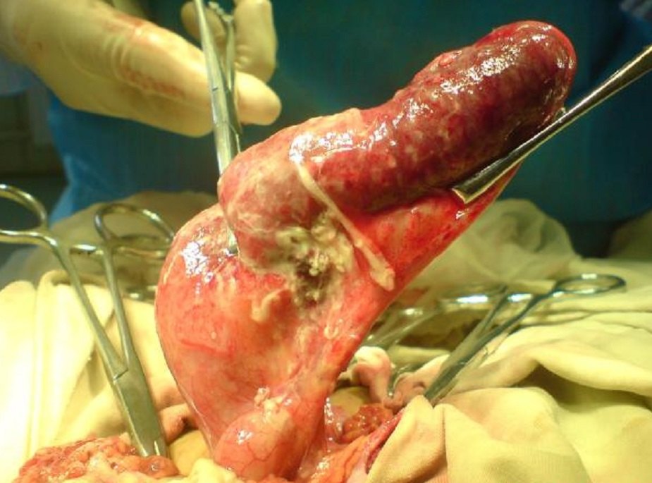 阑尾炎,想说爱你不容易