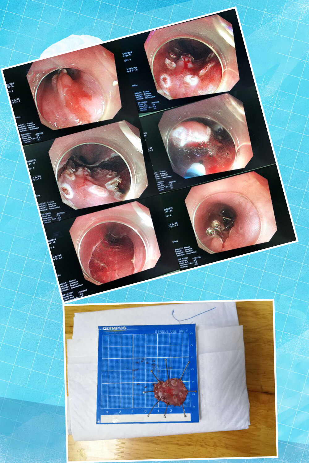 早期食管癌esd(内镜下黏膜剥离术)术后及预防