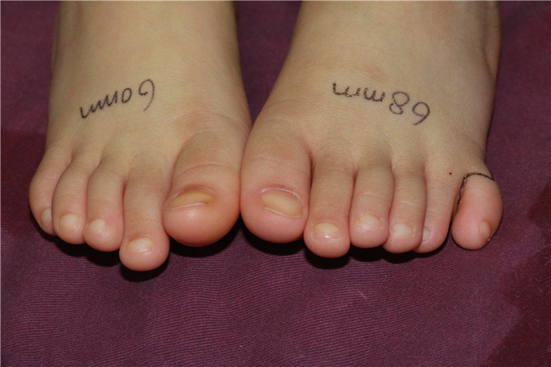 六趾畸形六个脚趾头迷信说法六趾畸形是什么原