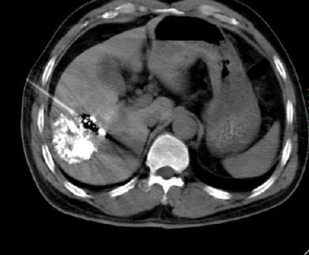 肝癌介入微创综合治疗