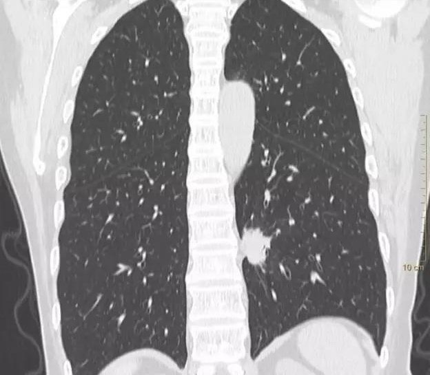 病例1浸润性肺腺癌