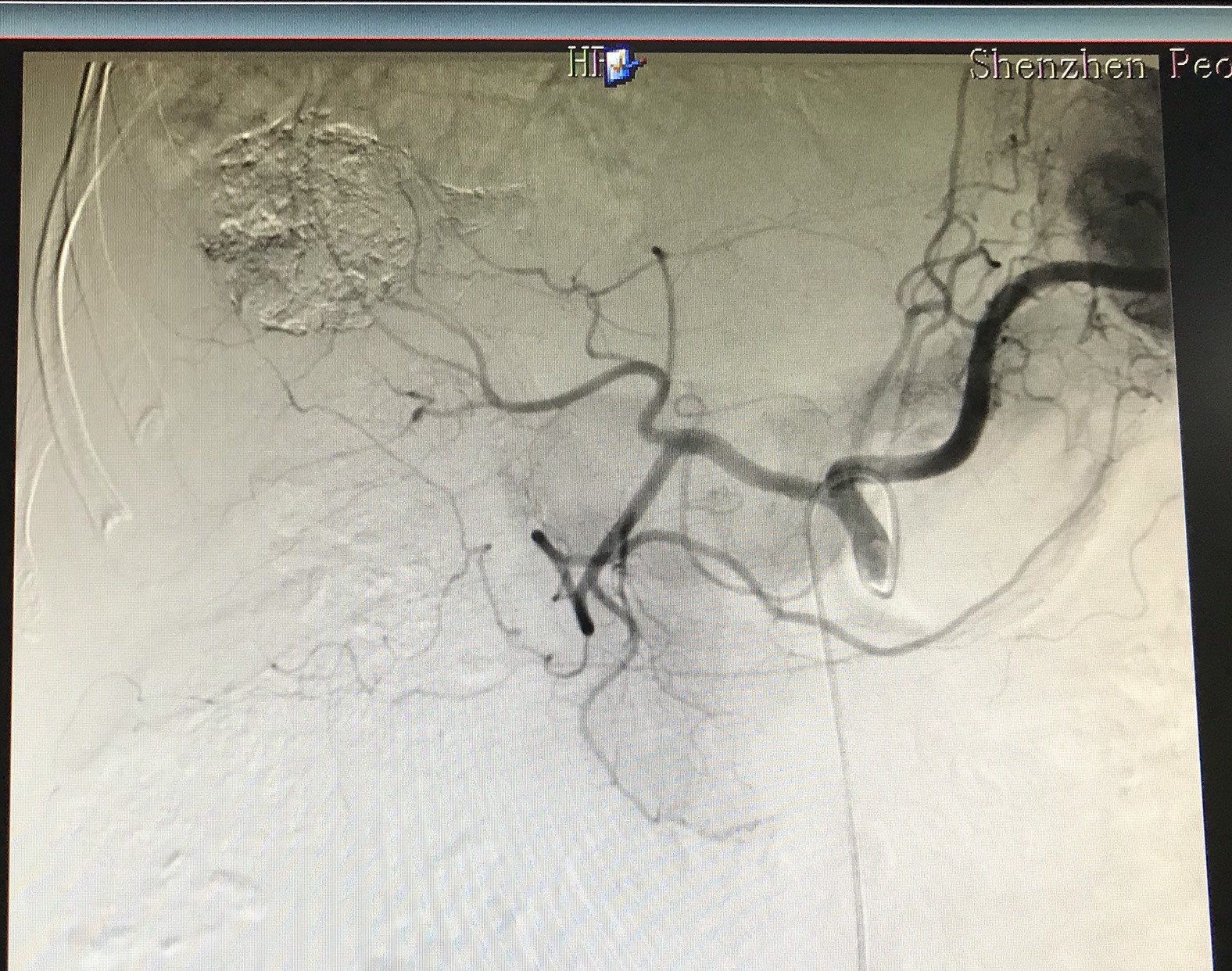肝静脉癌栓的氩氦刀冷冻消融治疗案例分享