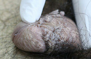 难治性生殖器尖锐湿疣