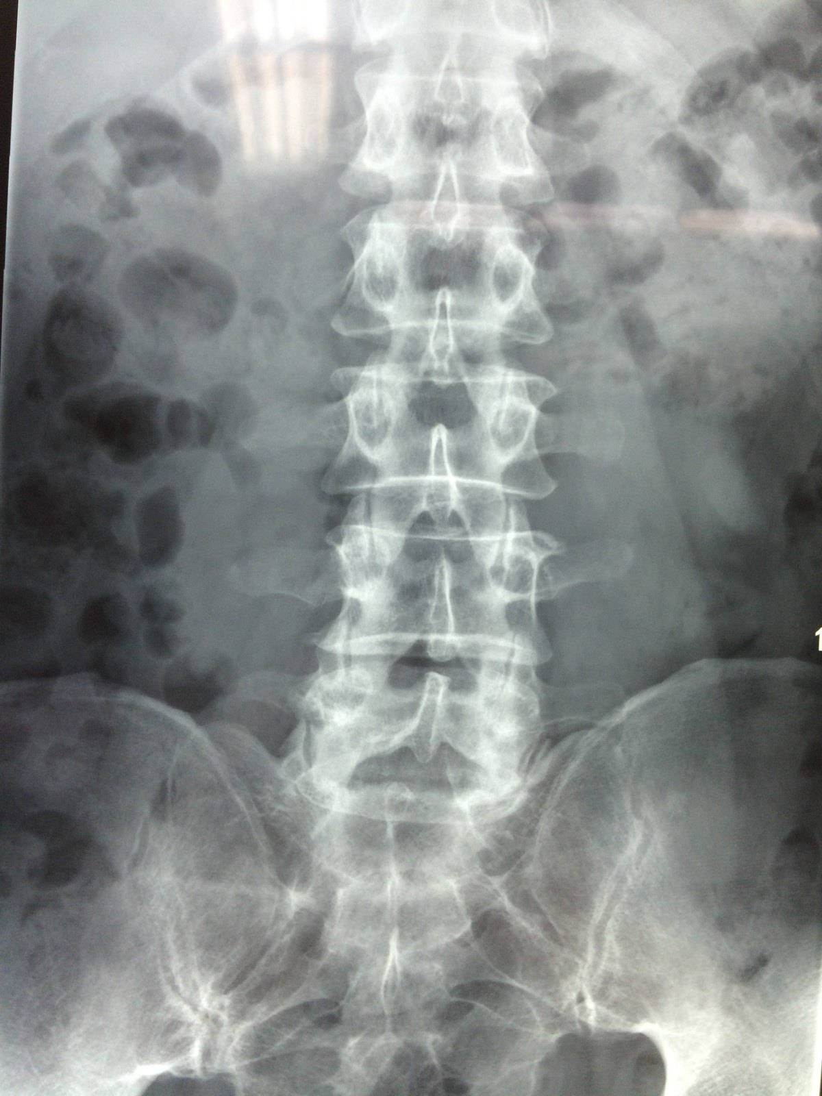 局麻麻醉,椎板间入路内镜微创腰椎间盘突出手