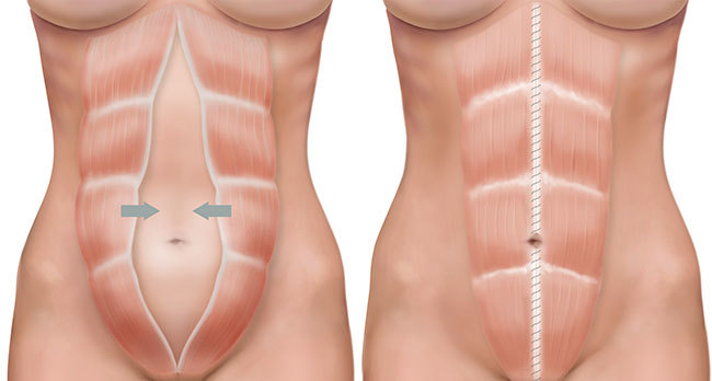 Diastasis-Recti.jpg