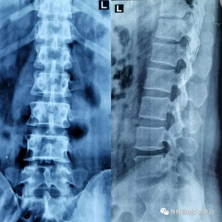 治疗腰间盘突出病例丨小孔镜,钓大鱼