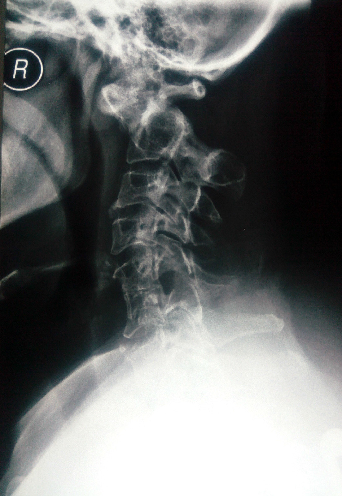 寰椎发育性椎管狭窄伴退变性颈脊髓病的影像学特点